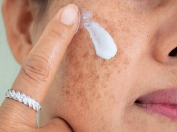 هشدار؛ مراقب سوختگی‌های پنهان آفتاب باشید