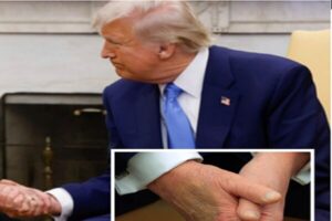 ابتلای ترامپ به «نارسایی مزمن وریدی»