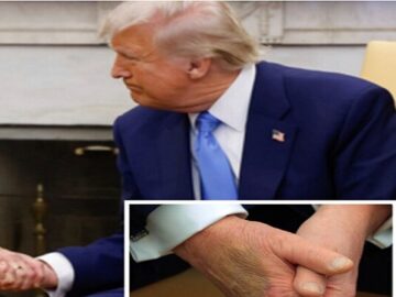 ابتلای ترامپ به «نارسایی مزمن وریدی»