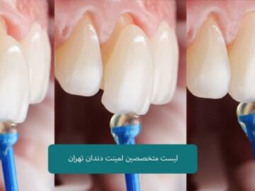 لیست متخصصین لمینت دندان در تهران