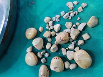 ۶۷ سنگ با ابعاد مختلف از مثانه بیمار در بیمارستان گناوه خارج شد