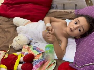 مقام بهداشتی غزه از افزایش ۲۲۵ درصدی قطع عضو در جنگ غزه خبر داد