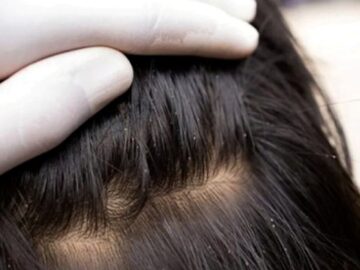 سن شایع آلودگی کودکان با شپش سر ۳ تا ۱۲ سال است