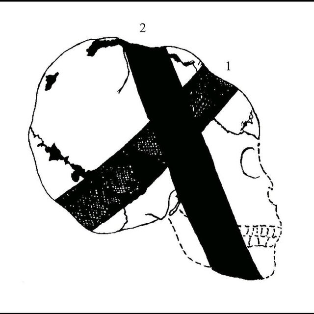 علت تغییر شکل عمدی جمجمه در عصر نوسنگی چه بود؟